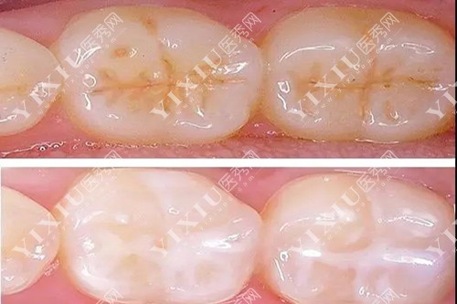 健康牙齿窝沟封闭示意图