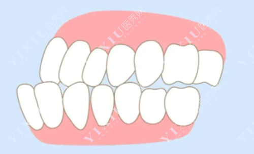 下颌骨十个做了九个后悔？正颌手术问题集锦一文看懂不迷茫！(图1)