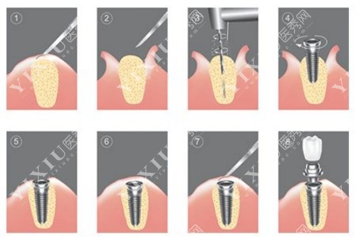 种植牙安装过程图