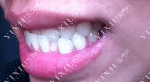 下颌骨十个做了九个后悔？正颌手术问题集锦一文看懂不迷茫！(图4)