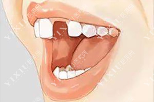 拔了多生牙半年多不长恒牙正常吗?列举不同原因和治疗建议(图5) 拔了多生牙半年多不长恒牙正常吗?列举不同原因和治疗建议(图5)