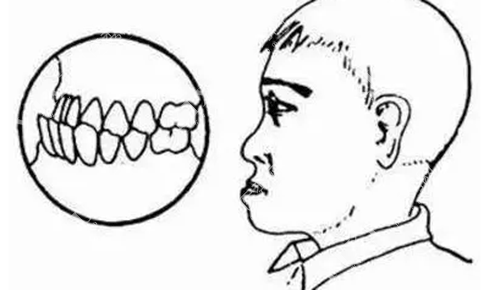 下颌骨十个做了九个后悔？正颌手术问题集锦一文看懂不迷茫！(图3)