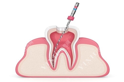 卡通牙齿根管治疗图