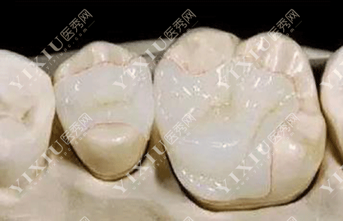 3m补牙和树脂补牙有什么区别?补牙材料该怎么选?内含价格!(图5) 3m补牙和树脂补牙有什么区别?补牙材料该怎么选?内含价格!(图5)