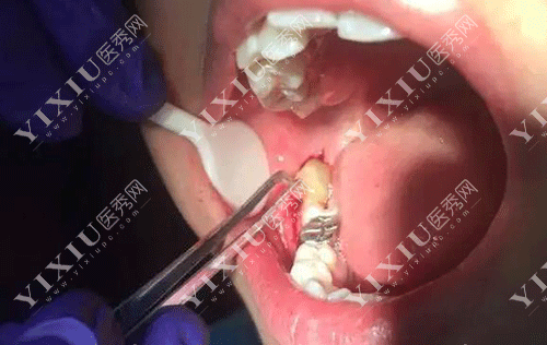 下颌骨十个做了九个后悔？正颌手术问题集锦一文看懂不迷茫！(图10)