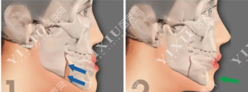 下颌骨十个做了九个后悔？正颌手术问题集锦一文看懂不迷茫！(图6)