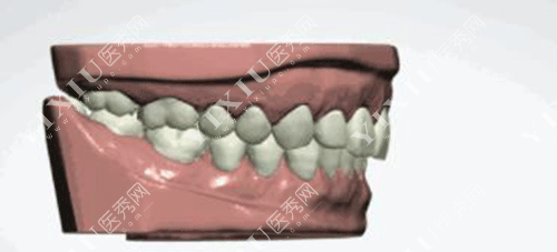 下颌骨十个做了九个后悔？正颌手术问题集锦一文看懂不迷茫！(图9)