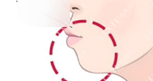 下颌骨十个做了九个后悔？正颌手术问题集锦一文看懂不迷茫！(图7)