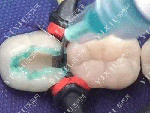 3m补牙和树脂补牙有什么区别?补牙材料该怎么选?内含价格!(图3) 3m补牙和树脂补牙有什么区别?补牙材料该怎么选?内含价格!(图3)