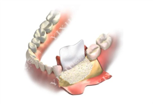 种植牙一期图
