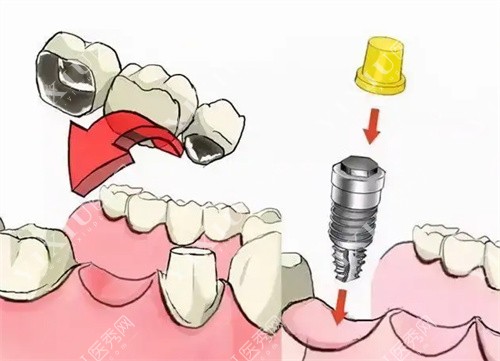 种植牙过程图