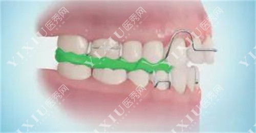 儿童牙齿颌垫矫治器的图片