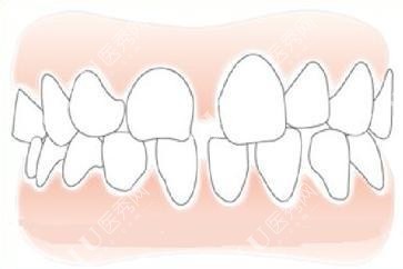 牙缝示意图