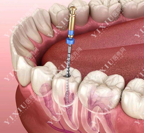 天津根管治疗收费标准