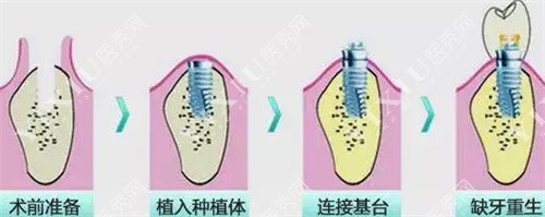 种植牙流程图