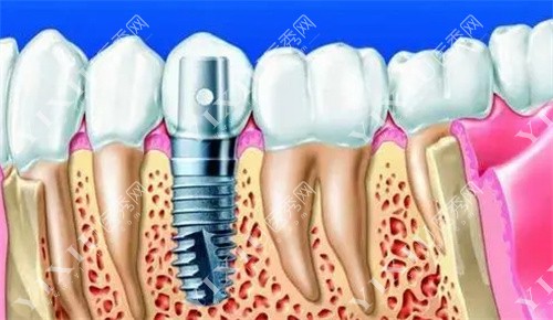 种植牙内部图