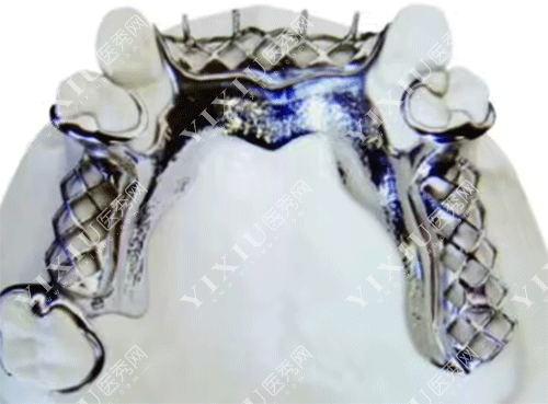 牙齿金属活动假牙的图片