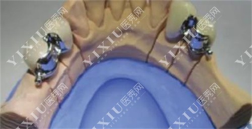 牙齿活动假牙修复牙齿的图片