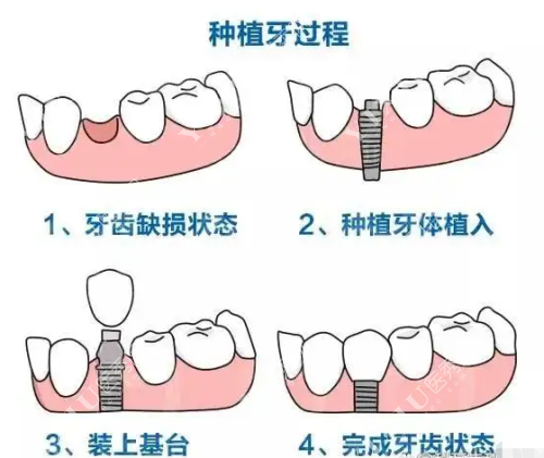 种植牙过程