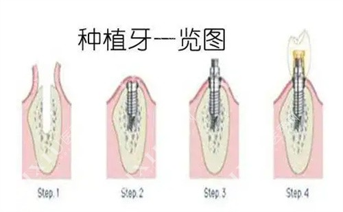 种植牙流程图