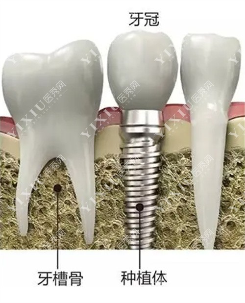 种植牙部位图