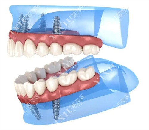 全口种植牙