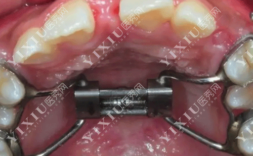 儿童牙齿扩弓的图片