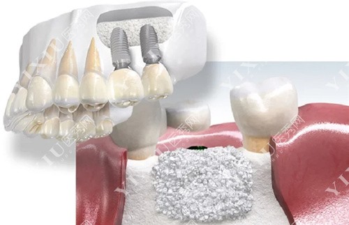 种植牙骨量缺失植骨