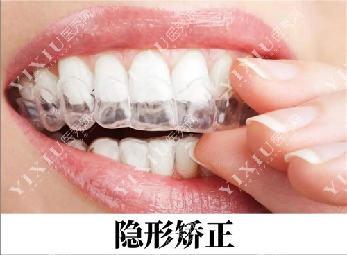 牙齿隐形矫治示意图