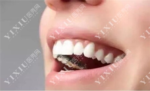 舌侧隐形矫正示意图