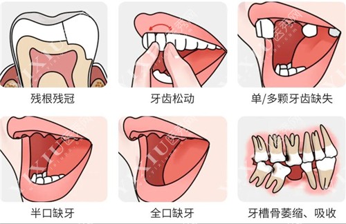 需要牙修复的情况示意图