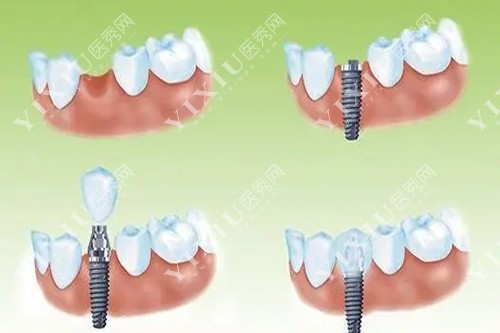 种植牙过程示意图