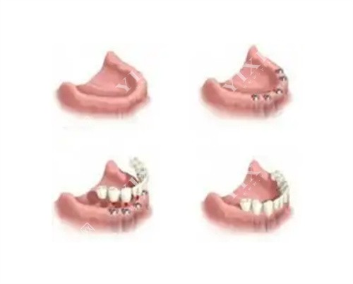 半口种植牙流程图
