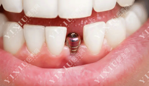 牙齿种植牙基台的图片