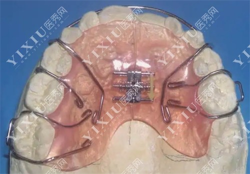牙齿可摘戴扩弓器图片
