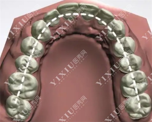 牙齿扩弓方案设计图片