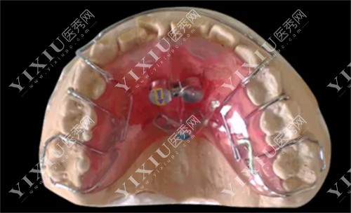牙齿扩弓器矫治器的图片