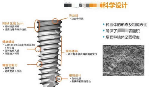 种植牙植体优势特点介绍