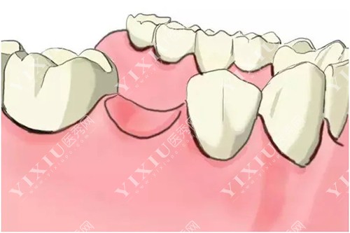 牙齿缺失示意图