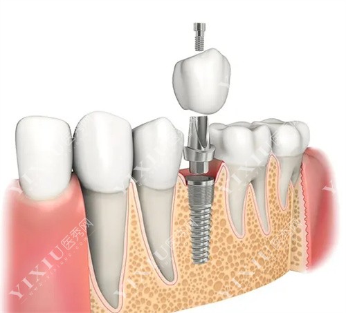 种植牙侧面图