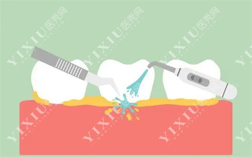 清理牙结石图