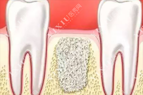 植骨示意图