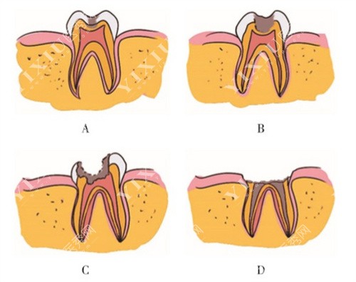 蛀牙过程图