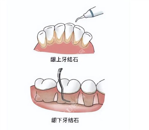 洁治对比图