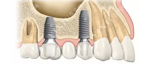 种植牙动画图