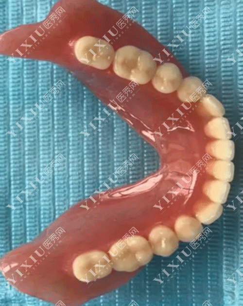 装半口树脂假牙的图片