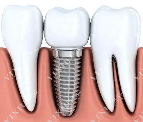牙齿种植牙使用范围的图片