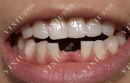 牙齿前牙缺失的图片