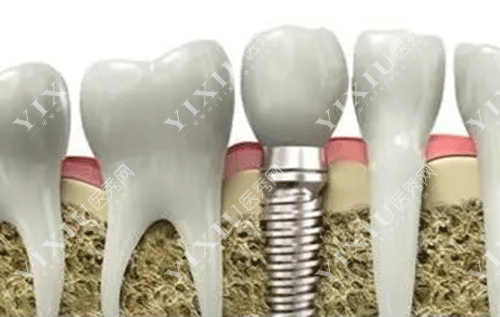 牙齿稳定性好的种植牙