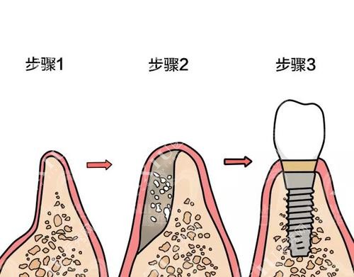 详解北京种植牙植骨价格是多少,看植骨种植牙费用要多少钱!(图6)